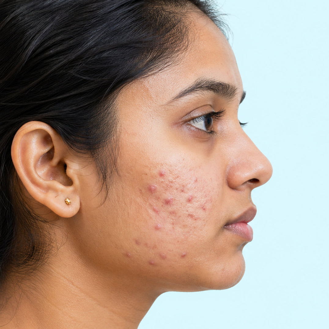 Anti Acne