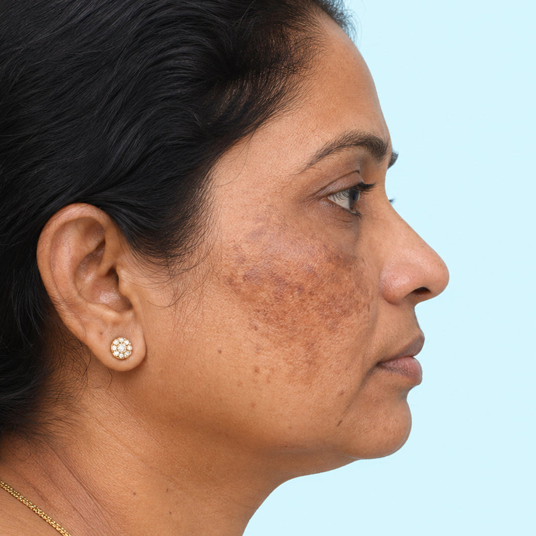 Anti Melasma