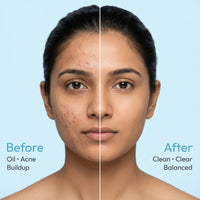 GLOWSOFT Anti-Acne Face Wash